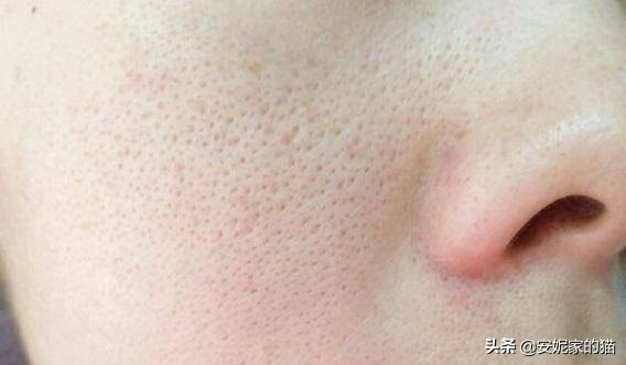 皮肤医生教你缩小毛孔,挤过的毛孔可以缩小吗