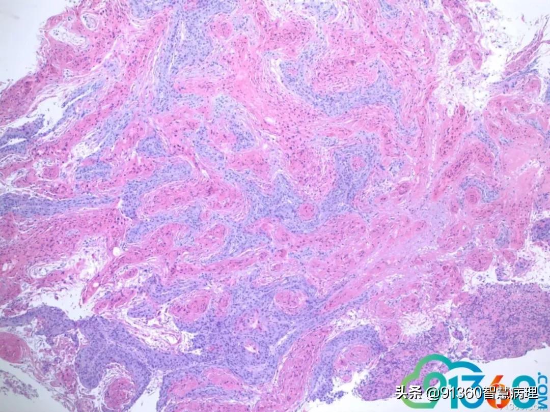 病理宫颈活检lsil是什么意思,宫颈病理检查与tct检查的区别