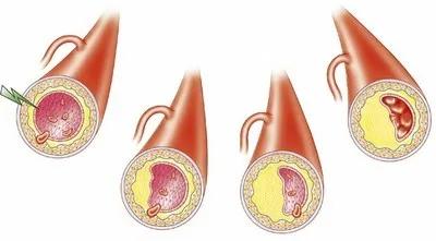 心血管动脉硬化应怎么调养,动脉硬化吃什么可以软化血管