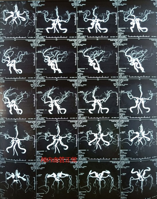 手指麻木不一定是颈椎病