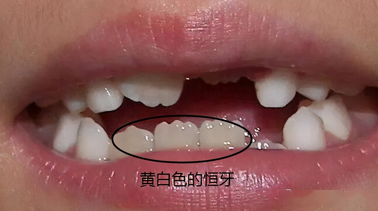 最全儿童换牙时间表家长必看,最全儿童换牙时间表