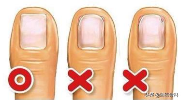脚趾甲没扎到肉但是很痛怎么回事,脚指甲扎穿肉