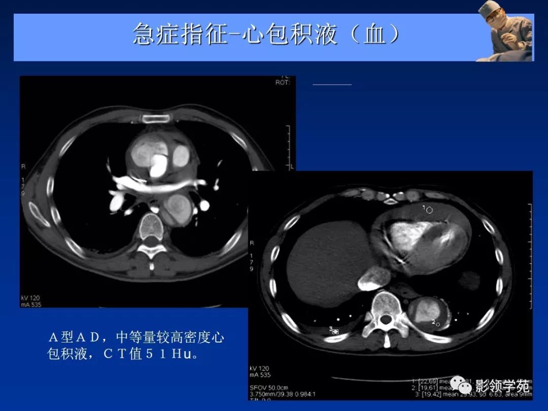 主动脉夹层壁间血肿如何鉴别,主动脉夹层血肿溃疡