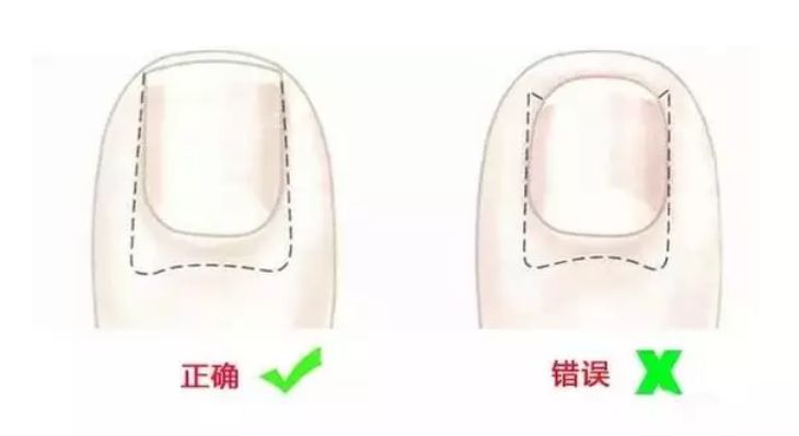 宝宝脚趾甲长到肉里怎么办,宝宝的脚趾总是弯着