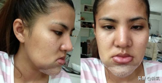 18岁土肥圆豪掷800万全身整形，鼻子6次大整假体穿出，效果却超美