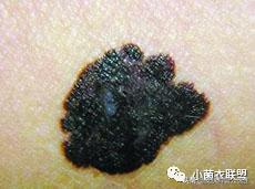 痣边缘模糊图片,痣长多大会变成黑色素瘤