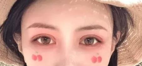 新月型双眼皮6.5毫米案例照片,自然款双眼皮有几种眼型图片