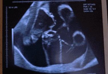 胎宝宝日常活动视频,胎宝宝运动视频