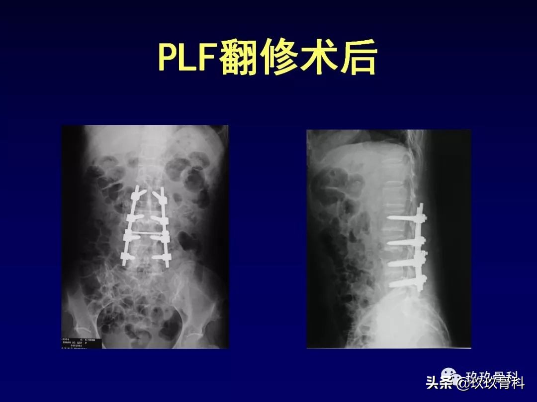 腰椎不稳最坏的结果,腰椎不稳的最佳治疗方法