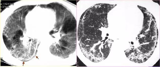 肺部ct十大征象,肺部ct正常图和异常图的区别