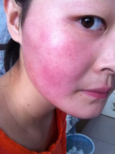 化妆品怎么测过敏,化妆品过敏怎么办