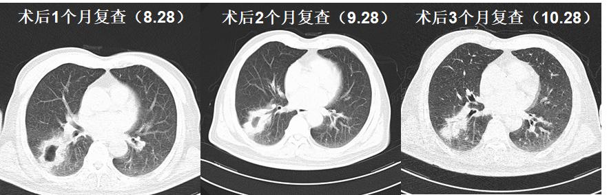 肺鳞癌介入治疗成功率,肺鳞癌最好的免疫化疗方案