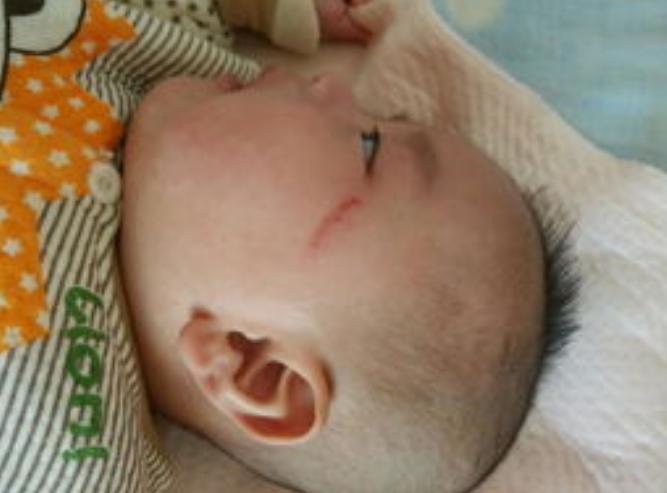 6岁小孩被妈妈批评反应,6个月宝宝脸上被划破会留疤吗