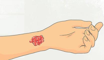 如果猫抓伤了手怎么办,家猫抓伤怎么办最快最有效