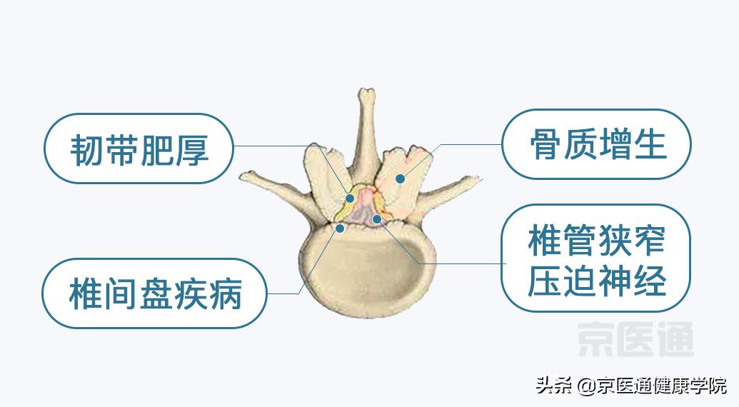 腰痛、腿痛是什么病？骨科医生用一块「羊蝎子」告诉你