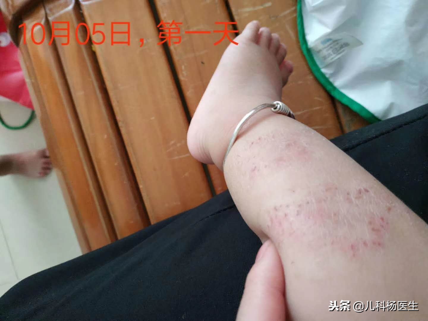 宝宝湿疹涂了炉甘石又严重了,宝宝湿疹抹了药更严重了