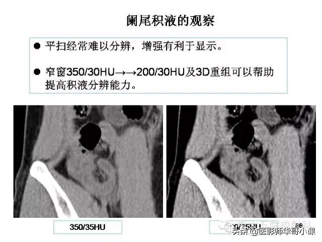 阑尾炎课件,阑尾炎的超声课件
