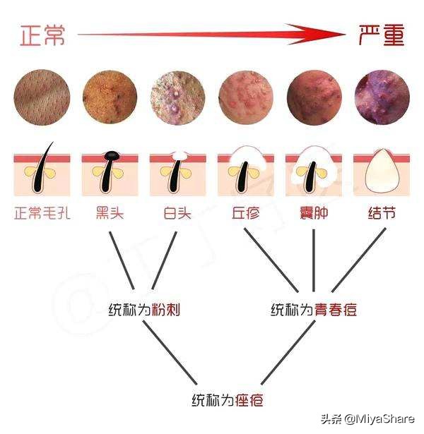 黑头清理攻略怎么样有效预防黑头,如何摆脱黑头反复的困扰才最有效