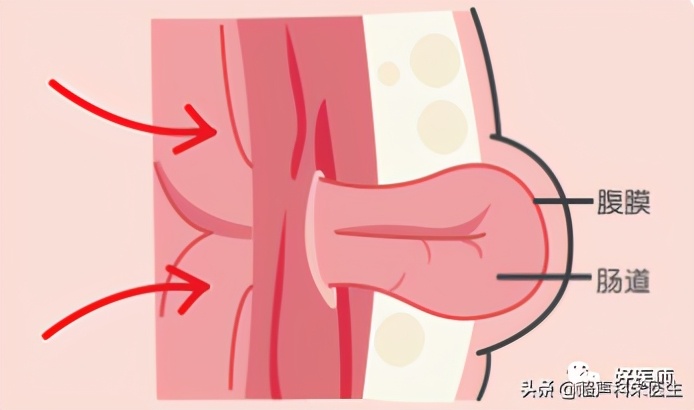 新生儿脐带未脱落前怎么穿尿不湿,新生儿脐带脱落前需要围腹围吗