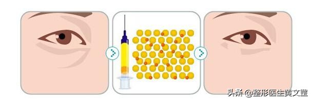 有了泪沟显老怎么办,有没有办法解决后天泪沟