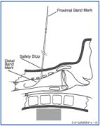 干货：气管切开术及护理措施