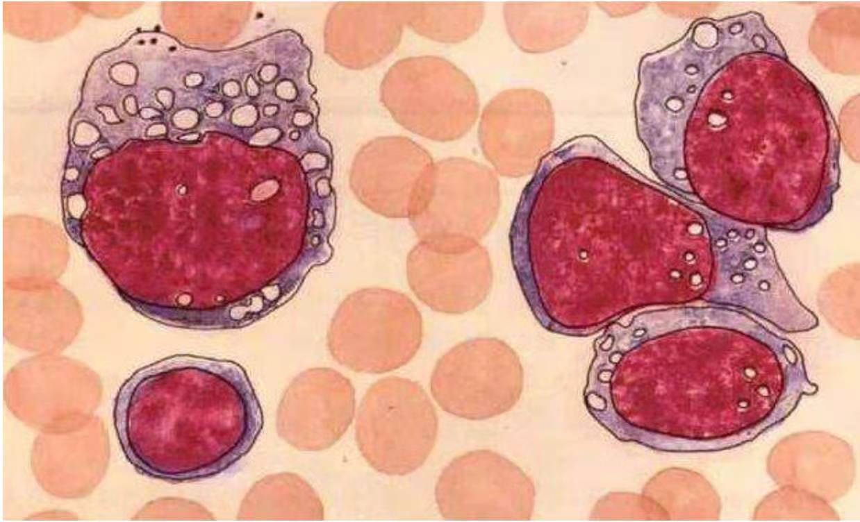 儿童特发性肺含铁血黄素沉着症,简述肺含铁血黄素沉着症定义