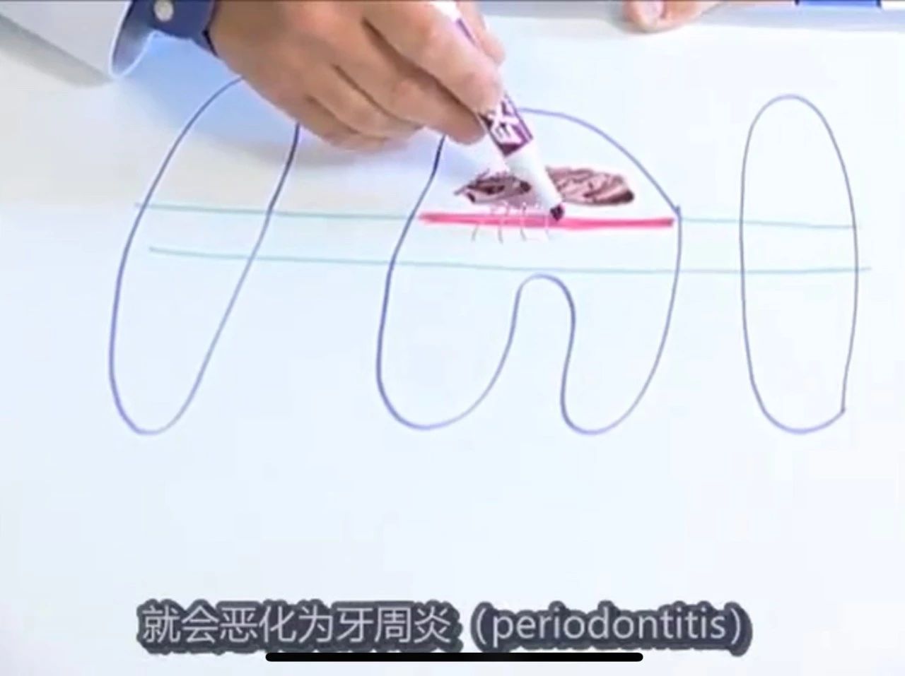 猫有牙结石牙龈红肿怎么治疗,猫已经有牙结石了怎么办