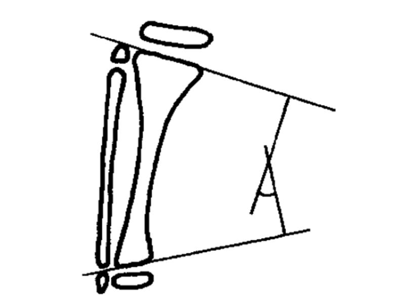 膝关节x线片可以查出啥,膝关节间隙x线测量方法