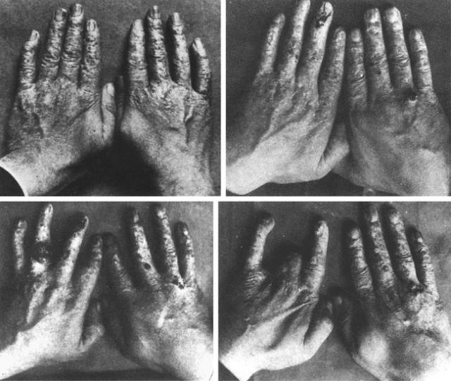 对x线辐射不敏感,x射线的发现和研究历史是怎样的