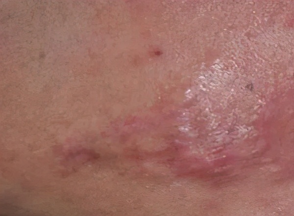 烧烫伤疤痕去除最好办法,烧烫伤疤痕怎么修复