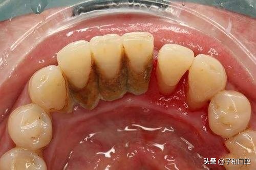 刷牙姿势不对导致补牙,刷牙姿势不对导致牙龈有裂痕