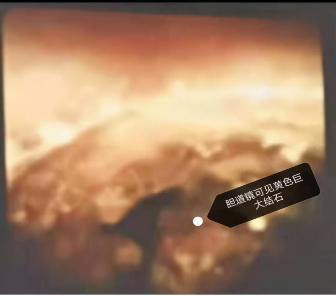 精益求精镜亦求净哈医大一院消化内科ERCP下取净胆管内2.5cm巨型结石