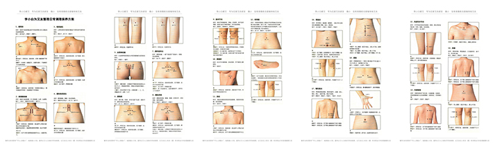 双侧肾俞环跳穴,腰肌劳损艾灸能治愈吗