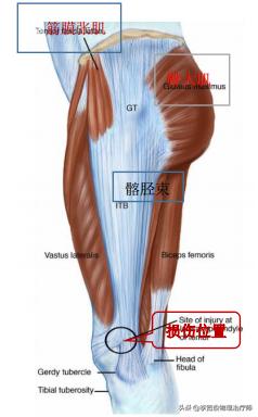 老生常谈跑步膝：髂胫束综合征（ITBS）