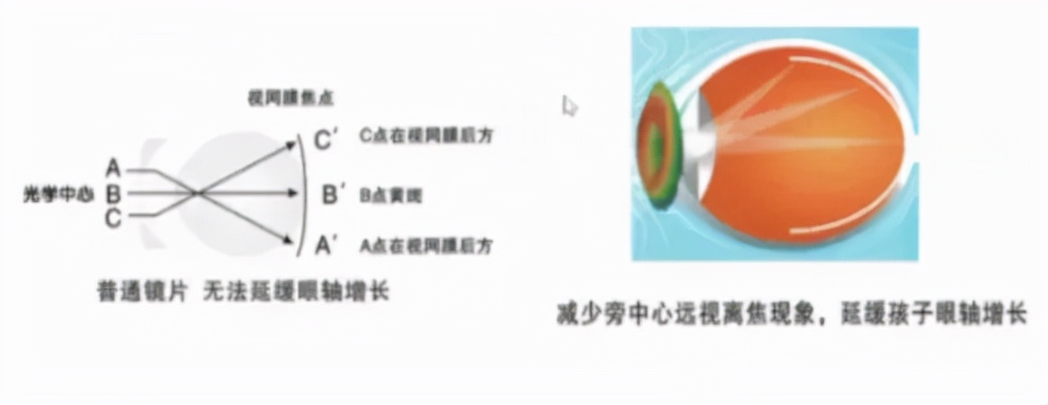 少年屈光不正怎么配镜,屈光参差的配镜原则讲解视频