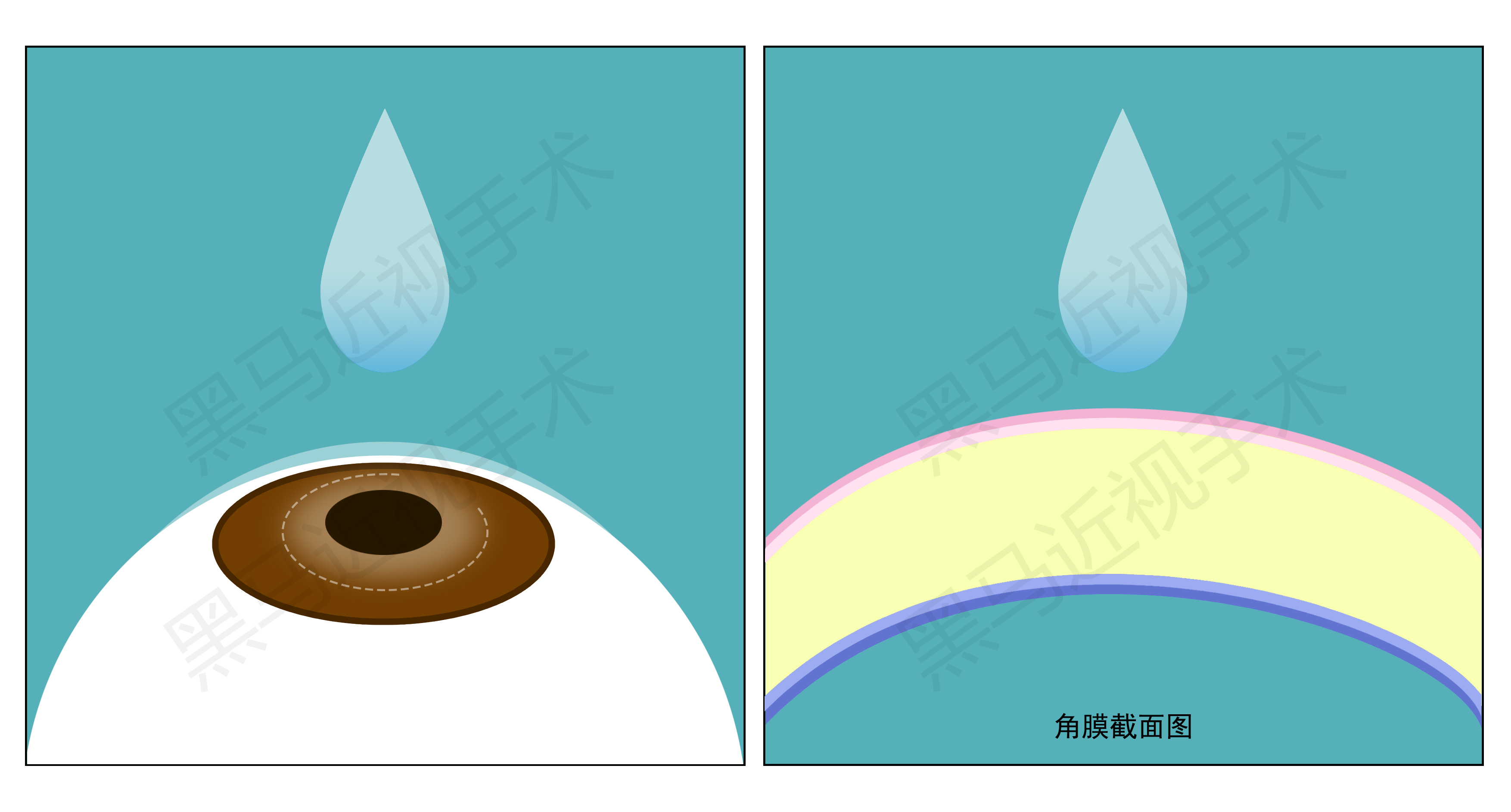 近视300度做激光手术会有后遗症吗,激光近视手术的后遗症有哪些知乎