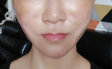 面部支架手术危险吗,做完面部支架有什么注意事项