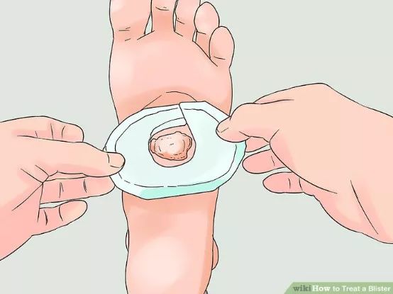 跑步脚上起水泡怎么处理好得快,脚跑步起水泡怎么处理好得快