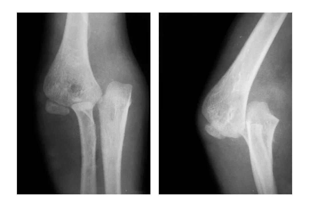 青少年肘部损伤最常见的是,肘部桡神经损伤的临床表现