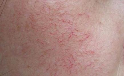 郭鸿财：皮肤薄一直泛红，对于这样的*血丝红**皮肤该如何保养呢？