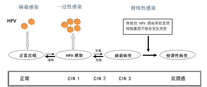 筛查出宫颈癌早期是幸运还是倒霉,筛选早期宫颈癌最常用方法