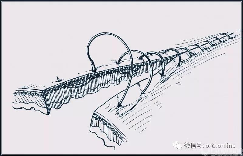 常用的手术缝合方法图,临床常见常用伤口缝合方法