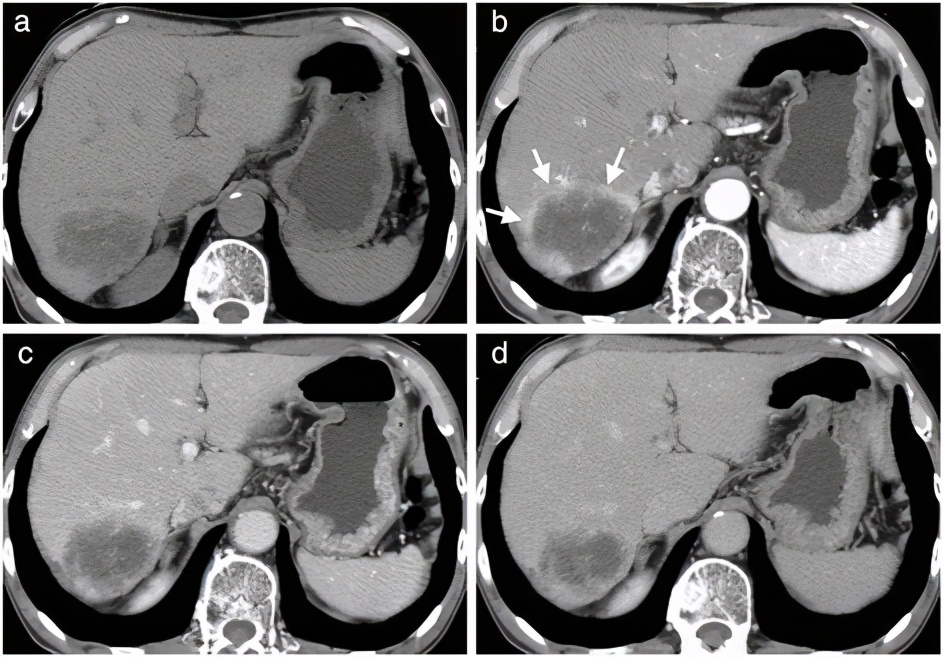 为什么肝血管瘤医生建议不用管,有了肝血管瘤要注意什么
