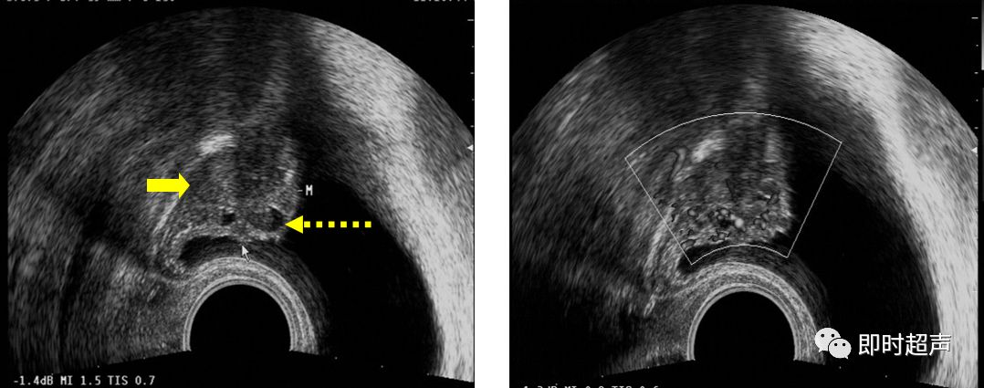 膀胱超声图解大全,膀胱超声解剖及常见病变超声表现