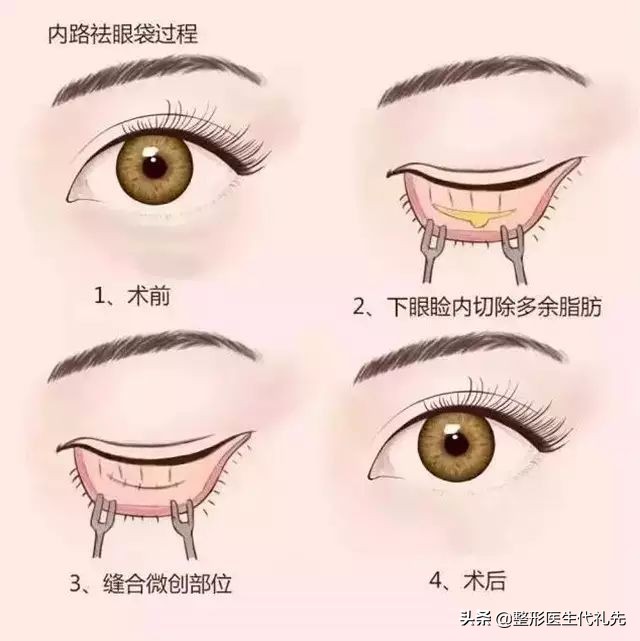 聊一聊35岁外切祛眼袋案例,为什么选择了外切而没有内切祛眼袋