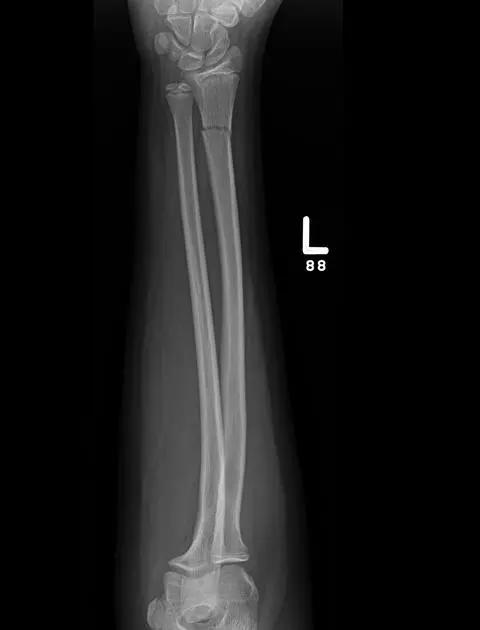 特殊骨折类型,特殊骨折体征