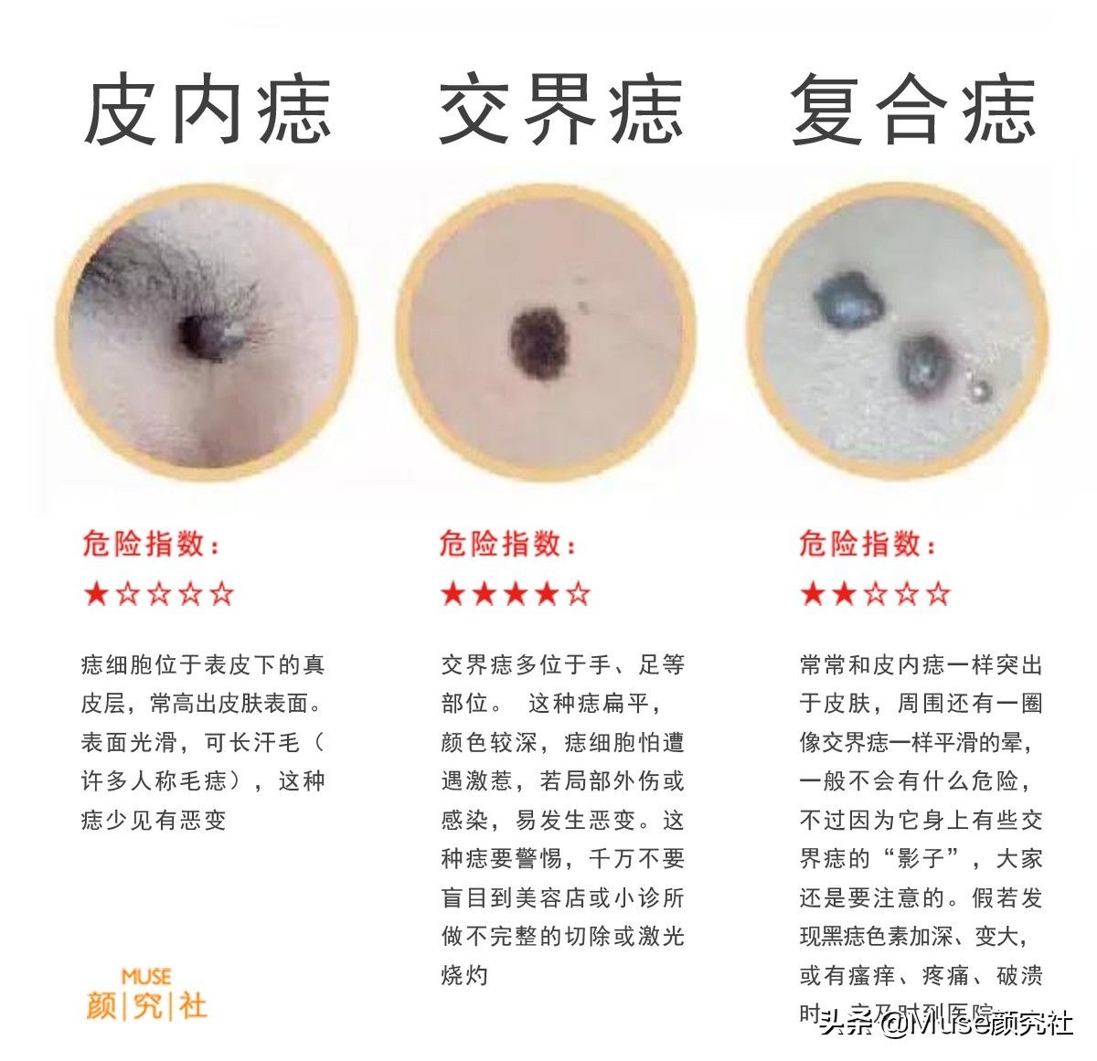 脸上长痦子是有福吗,脸上很容易长痣是什么原因