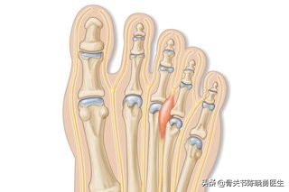 腰间盘突出跑步一跑就脚麻,跑步的时候脚麻是怎么回事
