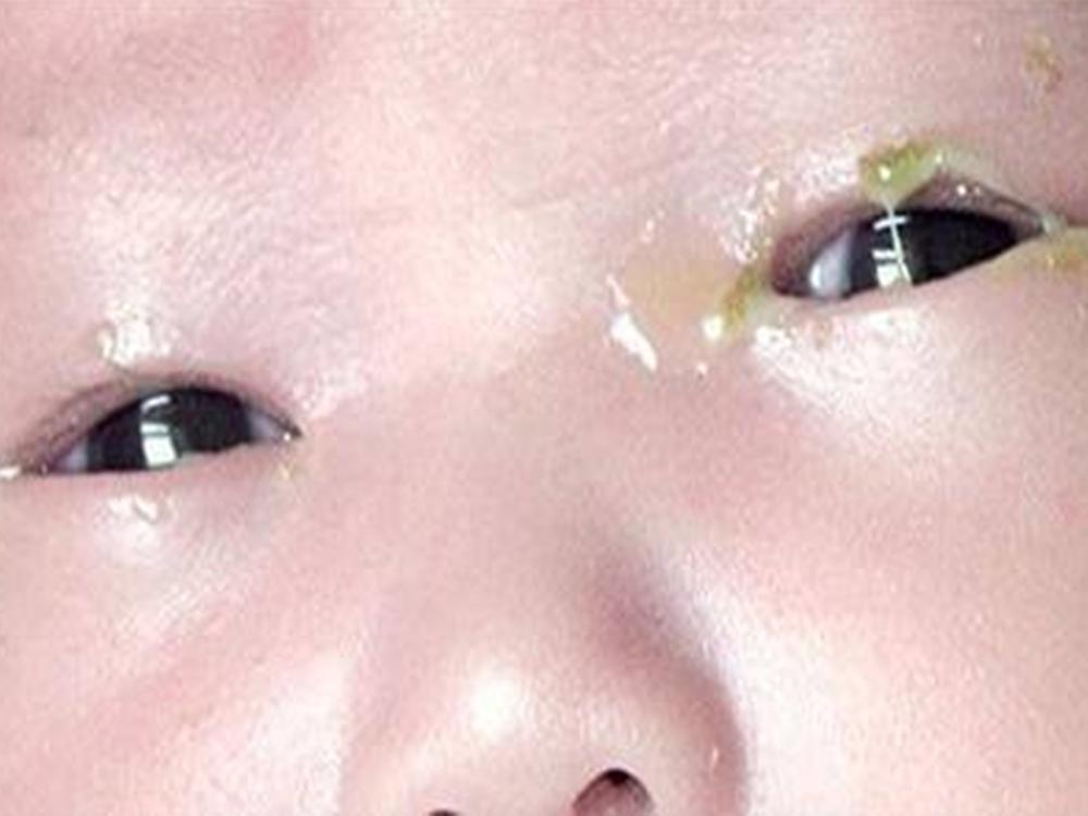 宝宝眼屎多且黄怎么办,宝宝眼屎多且黄还粘稠怎么食疗