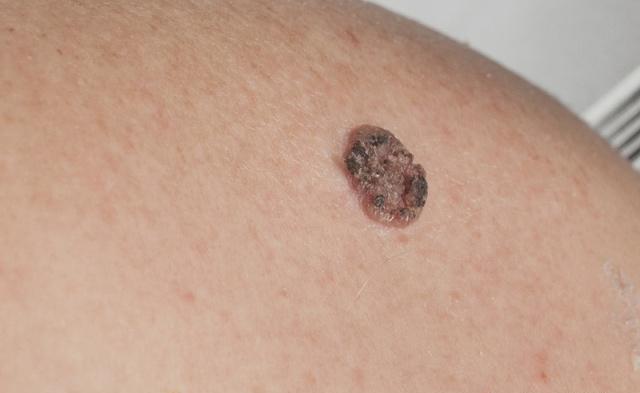 黑色素痣恶化为黑色素瘤的前兆,黑色素瘤会不会危及生命